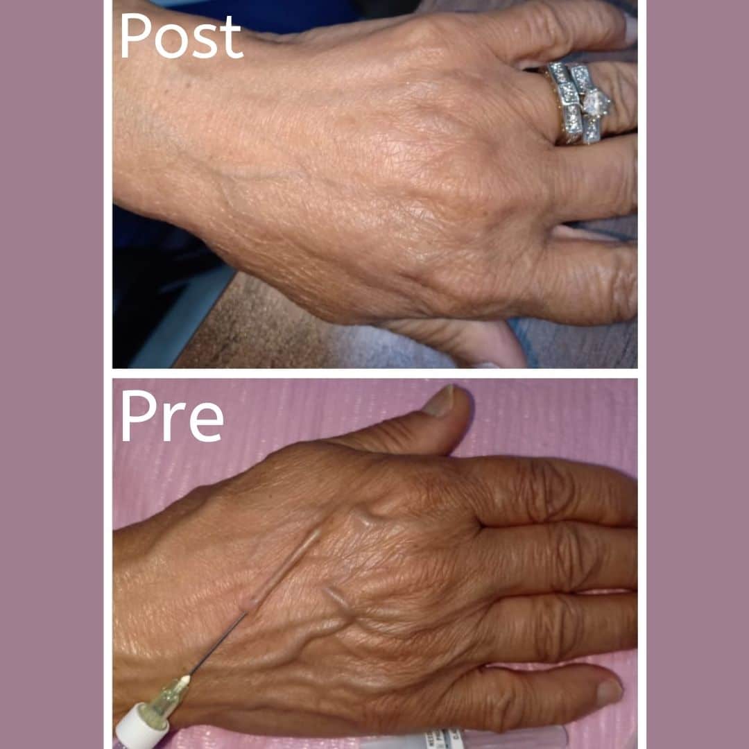 حقن الفيلر لليدين والكفين